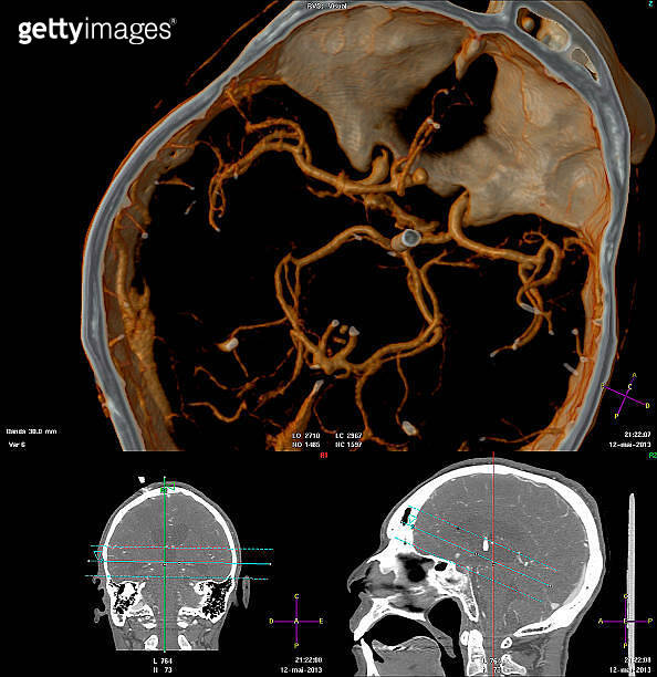 3D computed tomography angiography of the brain (178044197) - 게티이미지뱅크