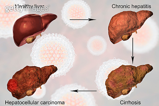 Liver disease progression in Hepatitis C virus infection (827341206 ...