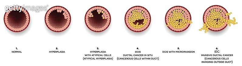 Breast cancer Ductal carcinoma of the breast (1074526112) - 게티이미지뱅크
