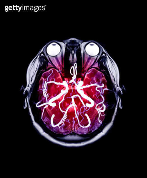 MRI brain and MRA Brain mix in axial view. (1186694398) - 게티이미지뱅크