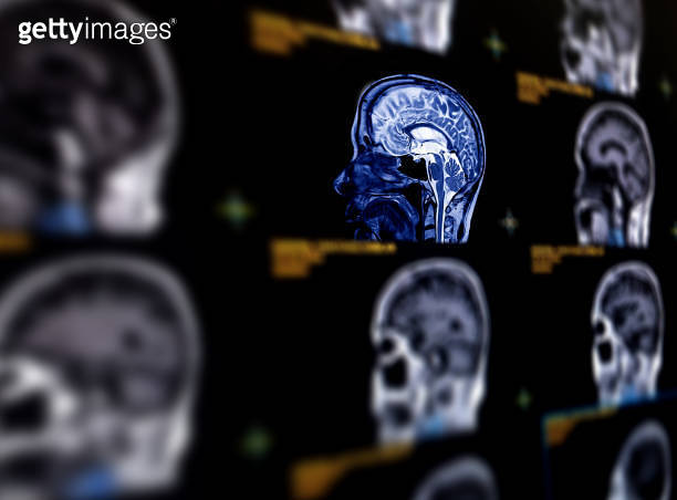MRI brain sagittal plane for detect a variety of conditions of the ...