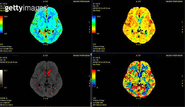 ct perfusion brain radiopaedia