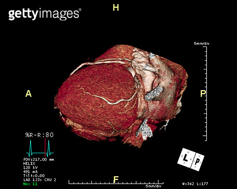 CTA Coronary artery 3D rendering image from the screen . CT angiography ...