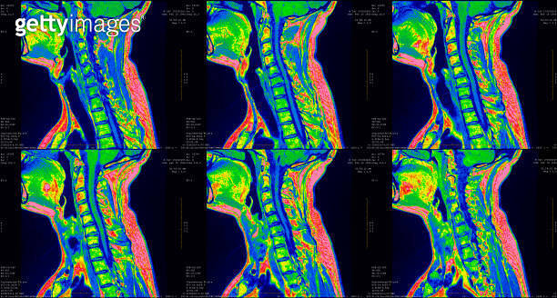 set of 6 sagittal green colored MRI scans of neck area of caucasian 34 ...