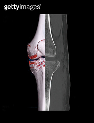Compare of CT knee joint 3D rendering image and CT knee 2D isolated on ...