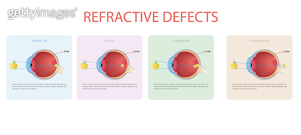 Refractive errors of vision,myopia,hyperopia,astigmatism (1409428523 ...