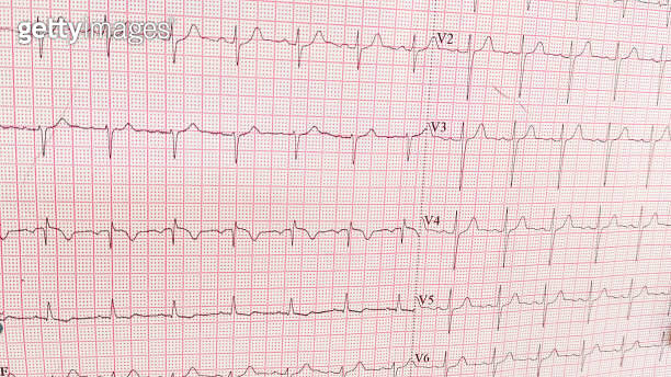 ECG pulse rate paper that shows sinus rhythm abnormality of right ...