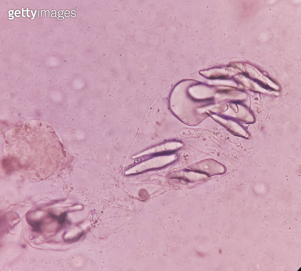 Giardia lamblia cysts and Trophozoite form, muscle fiber in stool examination, under 40X light