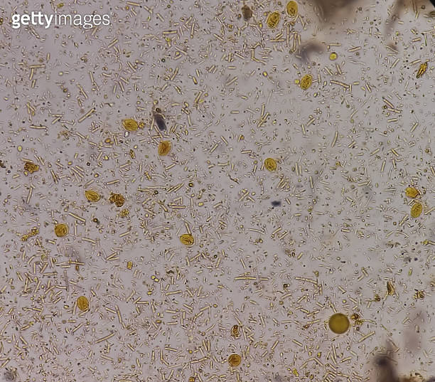 Giardia lamblia cysts and Trophozoite form, muscle fiber in stool examination, under 40X light