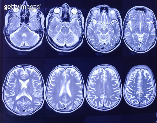 MRI (Magnetic Resonance Image) of brain. Cerebral cortical atrophy ...