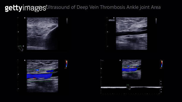 Color Doppler ultrasound determination in deep vein thrombosis patients ...