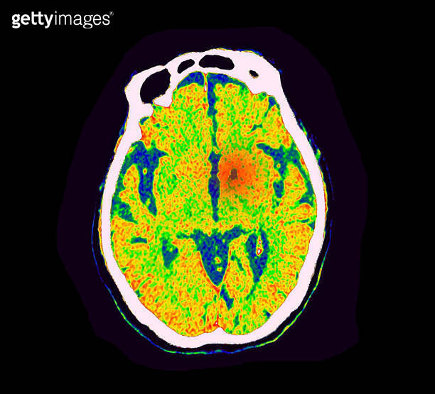 ct perfusion brain radiology