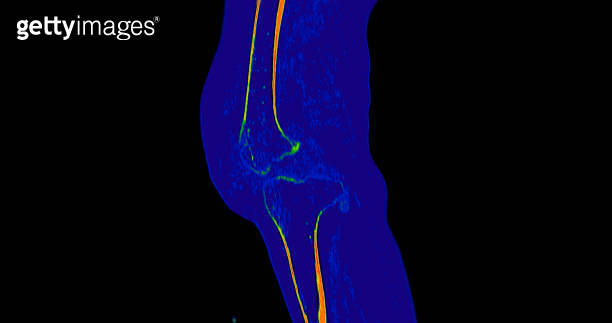 CT Knee or CT Scan image of knee joint sagittal view . (1701666912 ...