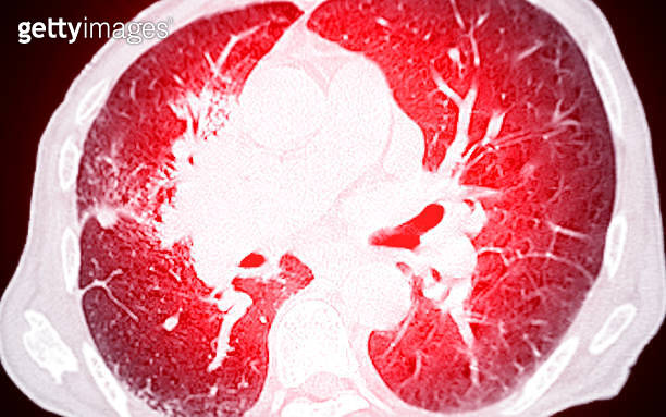A CT scan of the chest, featuring the lungs and heart, used for ...