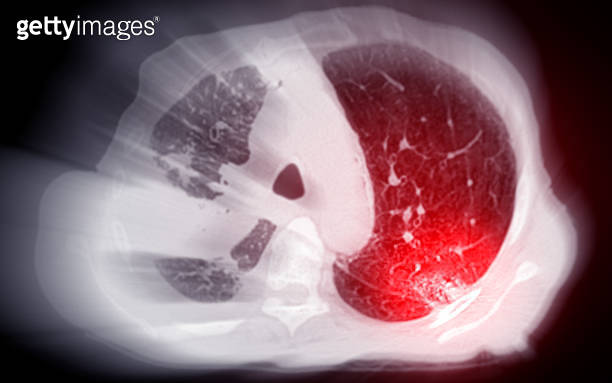A CT scan of the chest, featuring the lungs and heart, used for ...