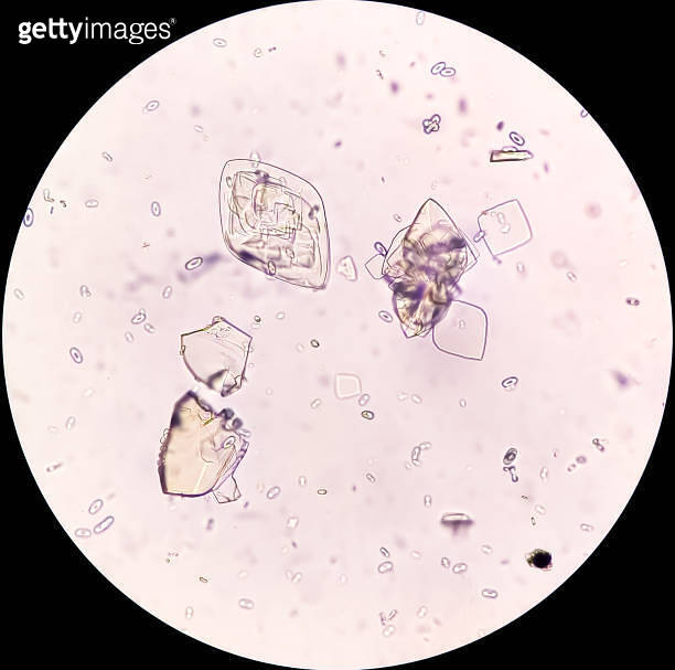 Uric acid crystals and calcium oxalate monohydrate under microscope ...