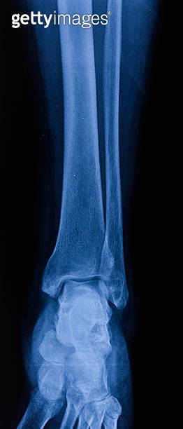 X-ray image of tibia and fibula 이미지 (92357457) - 게티이미지뱅크