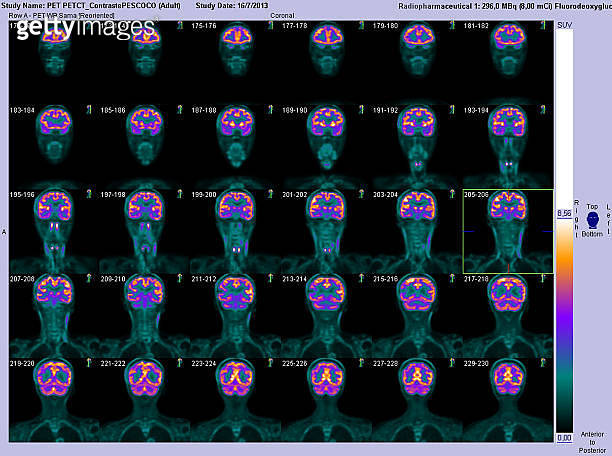 PET-CT coronal scan of the brain 이미지 (175635229) - 게티이미지뱅크