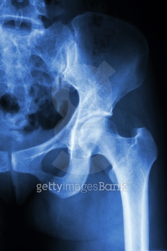 normal human's hip 이미지 (491244597) - 게티이미지뱅크