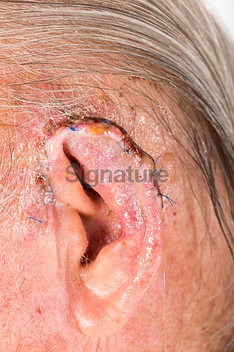 Mohs surgery on mans ear 이미지 (519013213) - 게티이미지뱅크