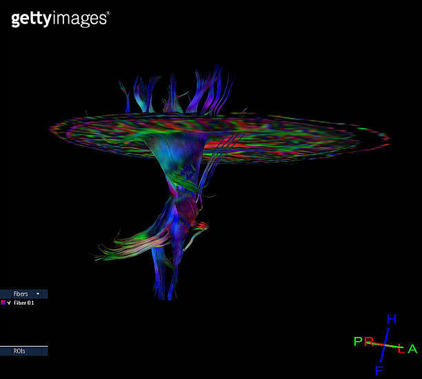 Tractography (DTI- diffusion tensor imaging MRI) of the brain ...