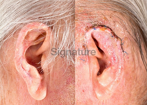 Mohs surgery on mans ear 이미지 (519013203) - 게티이미지뱅크