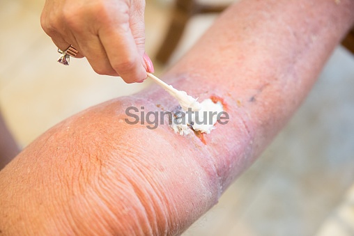 Ointment being applied after Mohs surgery on mans leg 이미지 (465035196