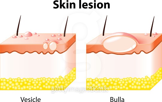 Vesicle and Bulla. Skin lesion (504902454) 일러스트, 무료 일러스트 - 게티이미지뱅크