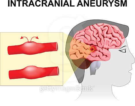 Intracranial aneurysm. cerebral or brain aneurysm. 이미지 (645057296) - 게티 ...