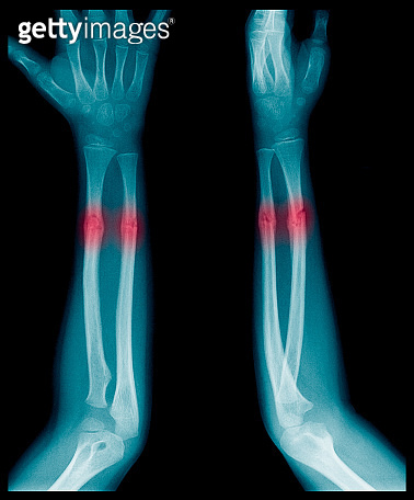 X-ray image of Forearm bone fracture in child's (Radius bone, Ulna bone ...
