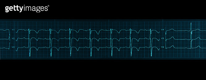 Medical research. Electrocardiogram. Horizontal fragment og ECG. Blue ...