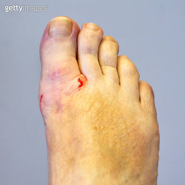 Local anaesthetic taking effect on a toe before surgery 이미지 (951636616