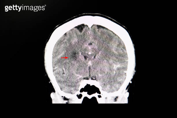CT brain scan in a stroke patient 이미지 (1165474875) - 게티이미지뱅크