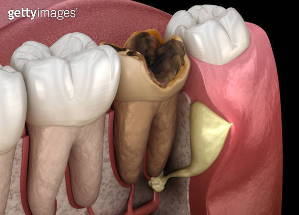 Periostitis tooth - Lump on Gum Above Tooth. Medically accurate dental ...