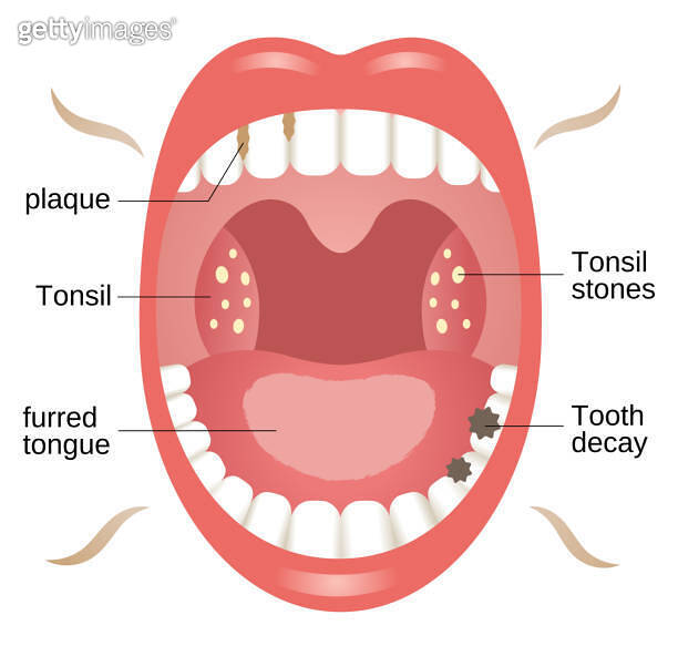 bad breath with tonsil stones, tooth decay, furred tongue, and plaque