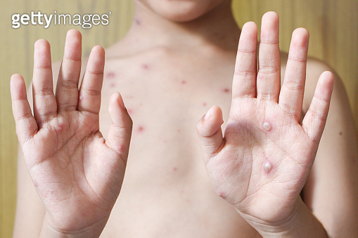 Chicken pox rash on young boy body.Chickenpox is an infection caused by ...