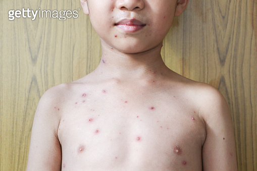 Chicken pox rash on young boy body.Chickenpox is an infection caused by ...