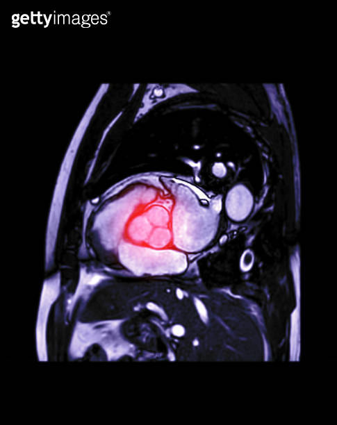 MRI heart or Cardiac MRI ( magnetic resonance imaging ) of heart ...