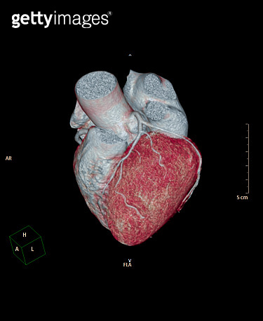 CTA Coronary artery 3D rendering image oblique view show coronary ...