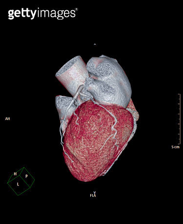 CTA Coronary artery 3D rendering image side view show coronary artery ...
