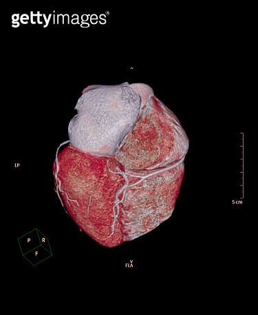 bottom view of CTA Coronary artery 3D rendering image show coronary ...