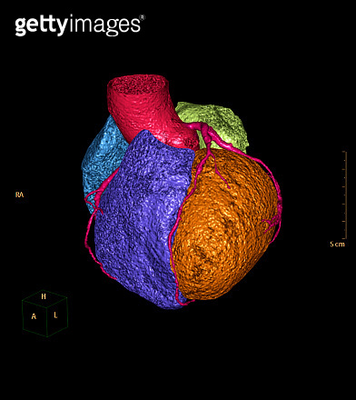 CTA Coronary artery 3D rendering image for detect coronary artery ...