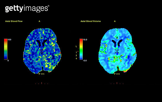 Red Brain Scan Perfusion CT scan of the brain ,The red and green and blue are areas of ...