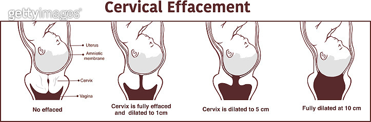 Effacement Testing Vector - Cervical effacement and dilatation during labor (1194625901 ...