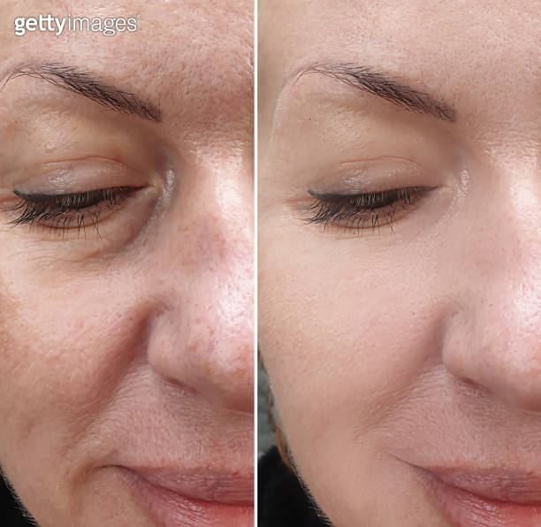 female face wrinkles before and after treatment collage 이미지 (1268498677 ...