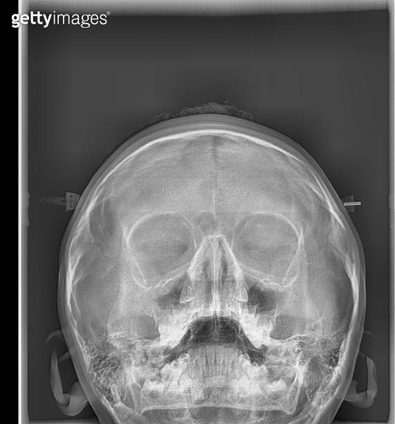 Dental xray of molars, crown, caries, implant. resonance