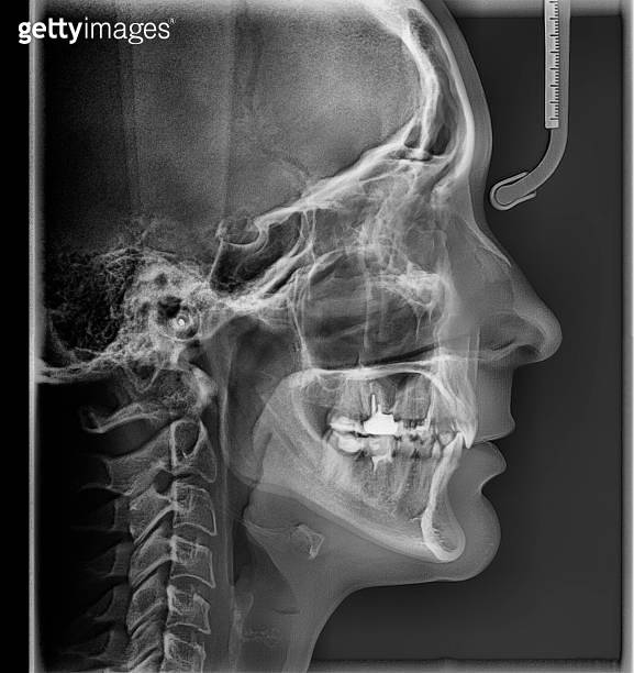 Dental xray of molars, crown, caries, implant. resonance