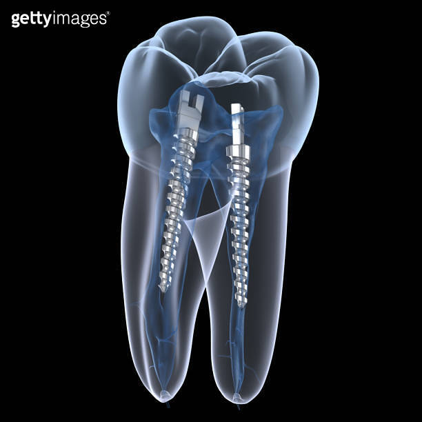 Dental steel post inside molar teeth, Xray view. Dental endodontic