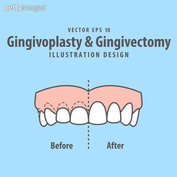 Compare upper teeth Gingivoplasty & Gingivectomy surgery before and