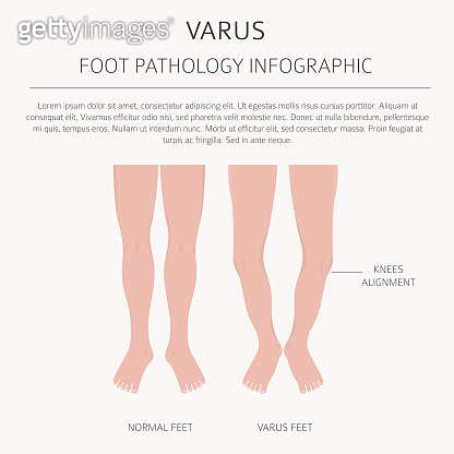 Foot deformation as medical desease infographic. Valgus and varus ...